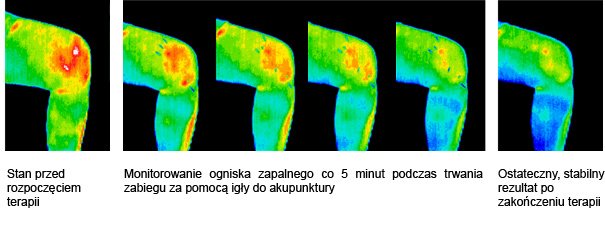 efekty akupunktury - termogram