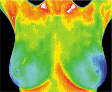 badanie piersi - termogram prawidłowy